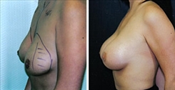 Breast Augmentation Patient Before & After Photo 1