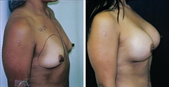 Breast Augmentation Patient Before & After Photo 1