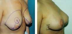 Breast Augmentation Patient Before & After Photo 1