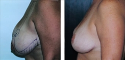 Breast Augmentation Patient Before & After Photo 1