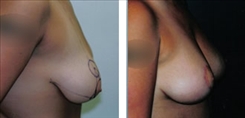 Breast Augmentation Patient Before & After Photo 1