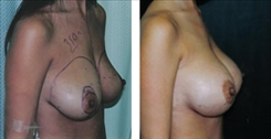 Breast Augmentation Patient Before & After Photo 1