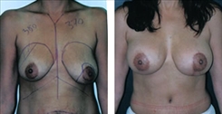 Breast Augmentation Patient Before & After Photo 1