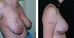 Breast Augmentation Patient Before & After Photo 1