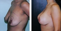 Breast Augmentation Patient Before & After Photo 1