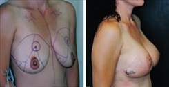 Breast Augmentation Patient Before & After Photo 1