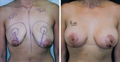 Breast Augmentation Patient Before & After Photo 1