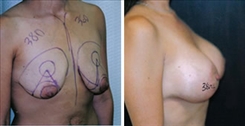 Breast Augmentation Patient Before & After Photo 1