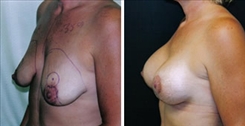 Breast Augmentation Patient Before & After Photo 1