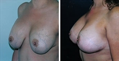 Breast Augmentation Patient Before & After Photo 1