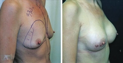 Breast Augmentation Patient Before & After Photo 1