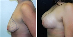 Breast Augmentation Patient Before & After Photo 1