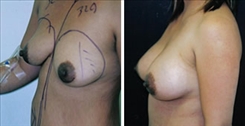 Breast Augmentation Patient Before & After Photo 1