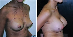 Breast Augmentation Patient Before & After Photo 1