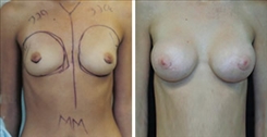 Breast Augmentation Patient Before & After Photo 1