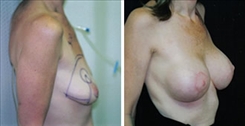 Breast Augmentation Patient Before & After Photo 1