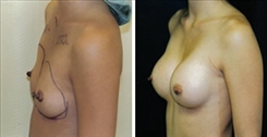 Breast Augmentation Patient Before & After Photo 1