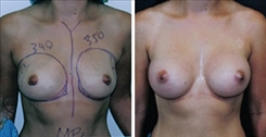 Breast Augmentation Patient Before & After Photo 1