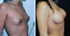 Breast Augmentation Patient Before & After Photo 1