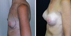 Breast Augmentation Patient Before & After Photo 1