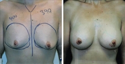 Breast Augmentation Patient Before & After Photo 1