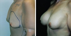 Breast Augmentation Patient Before & After Photo 1