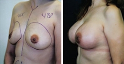 Breast Augmentation Patient Before & After Photo 1