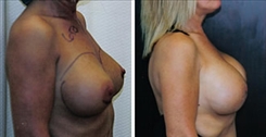 Breast Augmentation Patient Before & After Photo 1