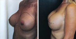 Breast Augmentation Patient Before & After Photo 1