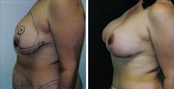 Breast Augmentation Patient Before & After Photo 1