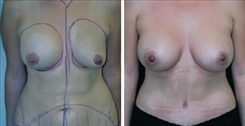 Breast Augmentation Patient Before & After Photo 1