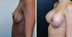 Breast Augmentation Patient Before & After Photo 1