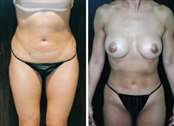 Breast Procedures Patient Before & After Photo 1
