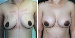 Breast Procedures Patient Before & After Photo 1