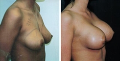Breast Procedures Patient Before & After Photo 1