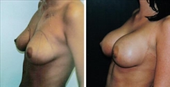 Breast Procedures Patient Before & After Photo 1