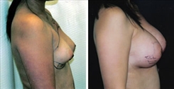 Breast Procedures Patient Before & After Photo 1