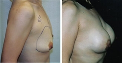 Breast Procedures Patient Before & After Photo 1
