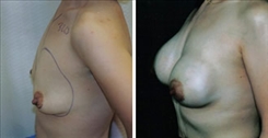 Breast Procedures Patient Before & After Photo 1