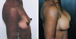 Breast Procedures Patient Before & After Photo 1