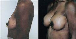 Breast Procedures Patient Before & After Photo 1