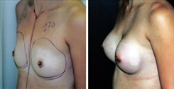 Breast Procedures Patient Before & After Photo 1