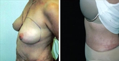 Breast Procedures Patient Before & After Photo 1