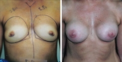 Breast Procedures Patient Before & After Photo 1