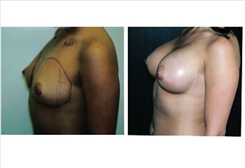 Breast Procedures Patient Before & After Photo 1