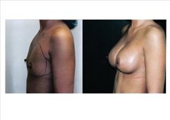 Breast Procedures Patient Before & After Photo 1