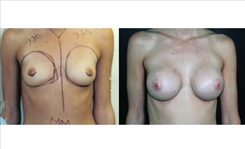 Breast Procedures Patient Before & After Photo 1