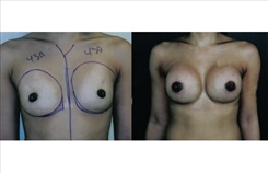 Breast Procedures Patient Before & After Photo 1