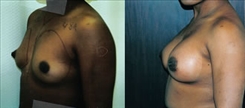 Breast Procedures Patient Before & After Photo 1