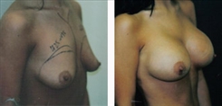 breast-augmentation-368b